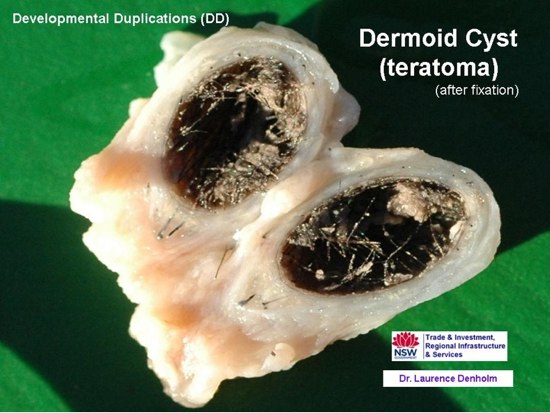 Image of bovine dermoid cysts