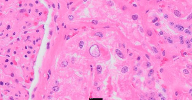 Photomicrograph of bovine kidney showing megalocyte with vesicular nucleus