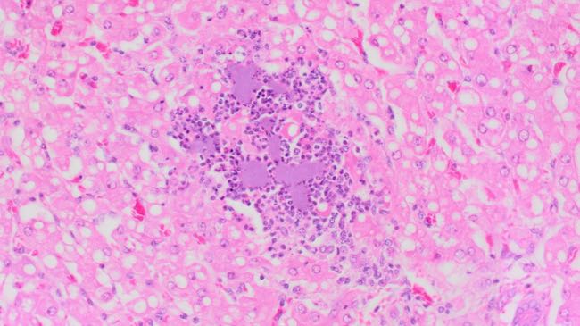 Photomicrograph of alpaca liver with Yersinia infection