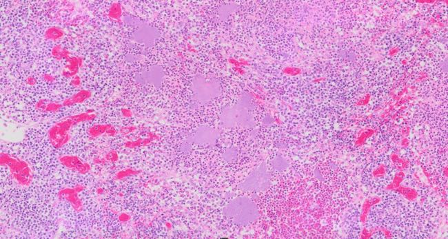 Photomicrograph of alpaca lymph node with Yersinia infection
