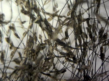 Lice eggs