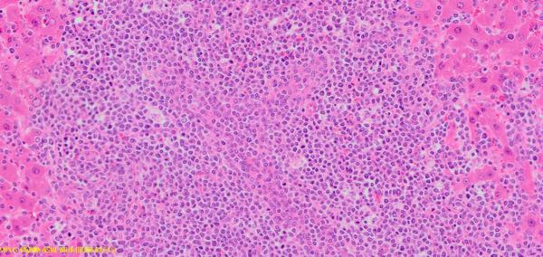 Photomicroimage of bovine neoplastic lymphoma