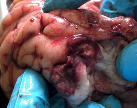 Cut surface of lesion