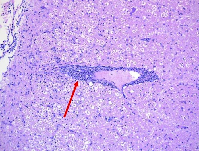 Photomicrograph of brain showing perivascular cuffing