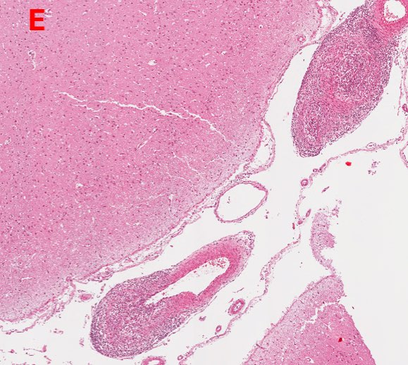 Photomicrograph of sheep brain showing mutlifocal vasculitis