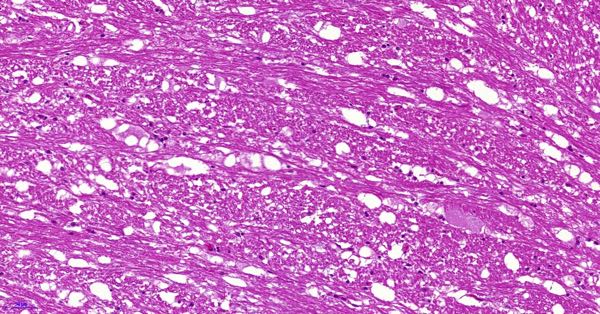 ovine segmental axonopathy trigeminal tract histopathology