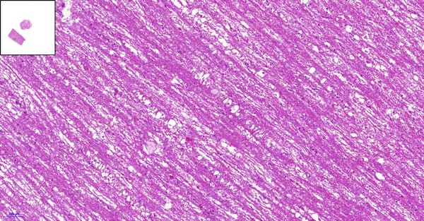 ovine segmental axonopathy trigeminal tract histopathology