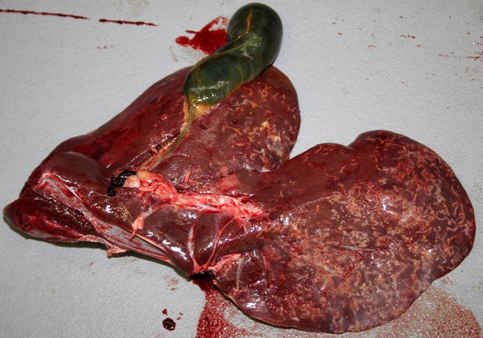 massive eosinophilic granulomatus hepatitis caused by cysticercosis