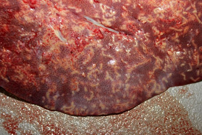 massive eosinophilic granulomatus hepatitis caused by cysticercosis