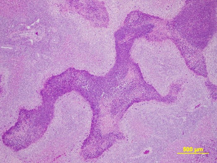 massive eosinophilic granulomatus hepatitis caused by cysticercosis