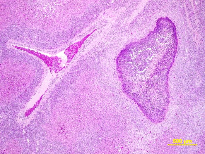 massive eosinophilic granulomatus hepatitis caused by cysticercosis