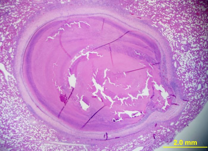 massive eosinophilic granulomatus hepatitis caused by cysticercosis