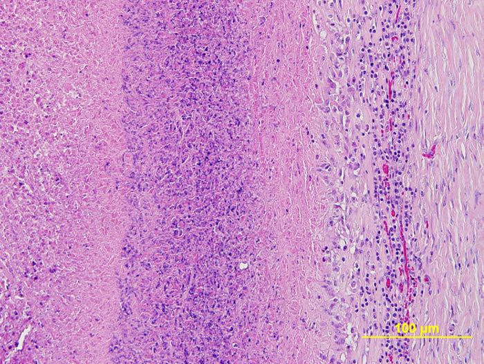 massive eosinophilic granulomatus hepatitis caused by cysticercosis