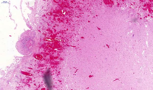 bacterial meningitis histopathology necrosis