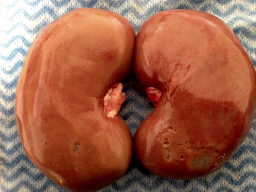 Image of nephritis