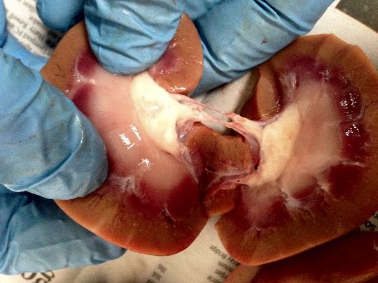 Image of nephritis