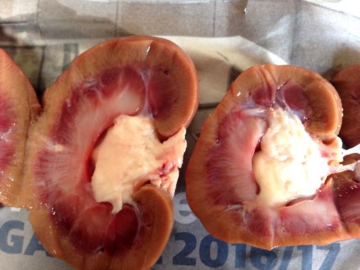 Image of nephritis