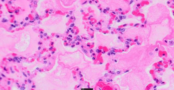 Photomicrograph of ovine lung showing congestion and intra-alveolar fluid
